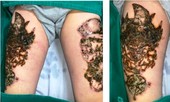 Hà Nội: Nam thanh niên 'nát bét' hai đùi vì biến chứng xóa xăm