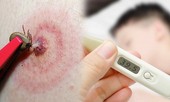 Phát hiện ca bệnh truyền nhiễm cực kỳ nguy hiểm ở Hòa Bình