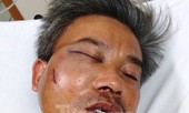 Chủ quán ‘Bố Già’ bị khởi tố vì đánh nhân viên cây xanh gãy hàm