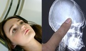 Bị đập đầu nên đi kiểm tra cho chắc, choáng váng phát hiện ra 2 cái kim nằm sâu trong não