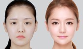 Định hình khuôn mặt Mewing: “Hô biến” cho khuôn mặt sắc nét không cần dao kéo?