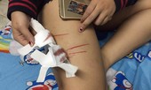 Nữ sinh ở TPHCM bị rạch đùi gây thương tích trên đường đi học về