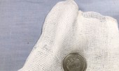 Cứu bé 3 tuổi bị đồng xu mắc chẹn ngang thực quản