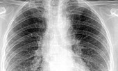 WHO nói gì về mức độ nguy hiểm của virus corona mới?