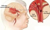Mỗi giờ có 12 người chết vì đột quỵ