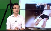 Người đàn ông mất cả chân lẫn tay sau 1 ngày tưởng là cảm lạnh