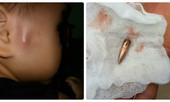 Đạn lạc găm trúng nhiều người dân ở Vĩnh Phúc
