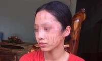 Trên mặt em H. có nhiều vết cào cấu, sưng đỏ.