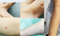 Đồng Nai phát hiện 1 ca đậu mùa khỉ, bạn gái cũng có triệu chứng mắc bệnh
