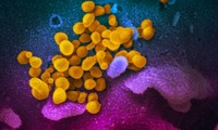 Ảnh chụp dưới kính hiển vi nhóm virus SARS-CoV-2 (màu vàng) trong một bệnh nhân người Mỹ