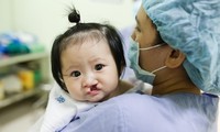 Điều trị từ trong thai kỳ cho trẻ bị khe hở môi vòm