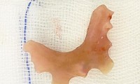Phát hiện hàm răng giả kẹt trong thực quản nữ bệnh nhân