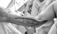 Cắt cánh tay cứu bệnh nhân nguy kịch vì nhiễm vi khuẩn đa kháng thuốc