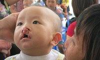 Mỗi năm, hàng nghìn trẻ chào đời bị dị tật hàm mặt