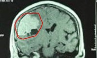 Đau đầu kéo dài vì khối u màng não &apos;khổng lồ&apos;