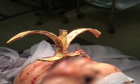 TPHCM: Người đàn ông bị sắt đâm xuyên trán, cắm thẳng vào hộp sọ