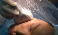 TPHCM:Liên tiếp 2 trường hợp biến chứng, hoại tử sau căng da mặt bằng chỉ 