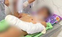 Bé trai 12 tuổi ở Đắk Lắk dập nát 2 bàn tay do pháo nổ