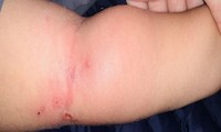 Bé 2 tuổi nhiễm trùng máu từ vết muỗi đốt