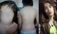 Bé trai bị bố đánh gãy xương, rạn sọ: Giảm 20kg vì bị bạo hành