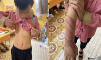 Hải Phòng: Làm rõ vụ bé trai 8 tuổi bị bạn trai của mẹ bạo hành