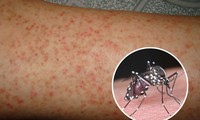 TP.HCM: Bệnh nhi đầu tiên tử vong do sốt xuất huyết trong năm 2018