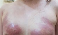 Cô gái 24 tuổi ở An Giang phải cắt một bên ngực vì bơm mỡ nhân tạo 