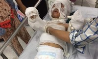 Bác sĩ thông tin về tình hình bé trai bị dì ruột tẩm xăng thiêu ở Vũng Tàu