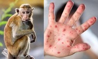 Long An ghi nhận ca mắc bệnh đậu mùa khỉ đầu tiên