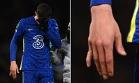 Ngôi sao Chelsea gãy ngón tay sau khi ghi bàn, cắn răng thi đấu hết hiệp 1