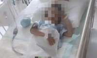 Trung Quốc: Nghi vấn bị mẹ ruột bạo hành, bé trai 5 tuổi phải cưa cả hai chân 