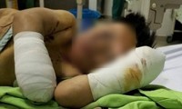 Bé trai tám tuổi thương tích nặng, cụt hai tay sau tiếng nổ lớn