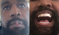 Gương mặt biến dạng của Kanye West sau khi nhổ hết răng