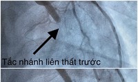 23 tuổi, nam thanh niên đột quỵ vì hút thuốc và nhậu trong nhiều năm