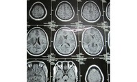 Hình ảnh chụp bệnh nhân bị sán làm tổ chi chít trong não (những chấm nhỏ màu đen là những tổ sán).