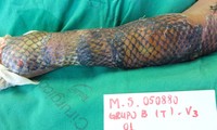 Da cá rô phi đang được các bệnh viện ở Brazil sử dụng như một phương pháp hữu hiệu để chữa bỏng. Ảnh: Ijf Burns Unit/Caters News Agency