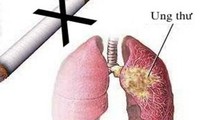 8 bệnh ung thư do hút thuốc lá
