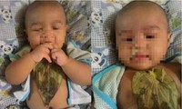 Đắp lá chữa sổ mũi, bé 6 tháng tuổi bị bỏng nặng