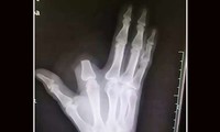 Người đàn ông Trung Quốc chặt ngón tay sau khi bị rắn cắn