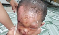 Nghi vấn bé trai ở TPHCM bị cha mẹ đánh đập dã man, trên người đầy vết thương