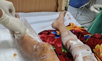 Lào Cai: Nam sinh bị chó thả rông cắn gây thương tích nặng