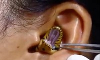 Nghi vấn clip rắn nằm trong tai người gây xôn xao ở Ấn Độ