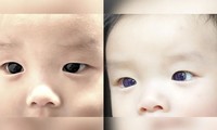 Điều trị bằng thuốc kháng virus khi mắc COVID-19, mắt bé trai bỗng nhiên đổi màu 
