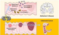 Người bị Alzheimer ít có nguy cơ mắc ung thư đại tràng và ngược lại, vì sao?