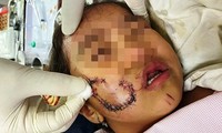 Bé gái 5 tuổi bị chó cắn phải khâu 50 mũi