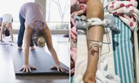 Cố “giúp” tập động tác thật chuẩn, giáo viên yoga ở Trung Quốc làm gãy xương đùi học viên