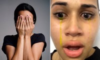 Cô gái khóc ra nước mắt màu vàng, hiện tượng này được giải thích thế nào?