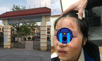 Vụ nữ sinh lớp 6 ở Hà Nội bị bạn làm tổn thương phần mặt: Nhà trường lên tiếng
