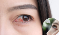 Cách điều trị đau mắt đỏ tại nhà: Không tự ý dùng thuốc nhỏ mắt có chất này