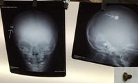 Hình ảnh chiếc đinh vít (đốm trắng) trên phim X quang hộp sọ chụp thẳng và chụp nghiêng và sau khi được gắp ra khỏi đầu bệnh nhi (ảnh dưới phải). Ảnh do bác sĩ cung cấp.